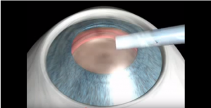 Refractive lenses ICL Animation